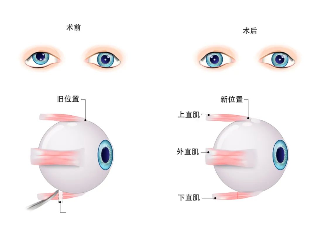 上斜視治療圖