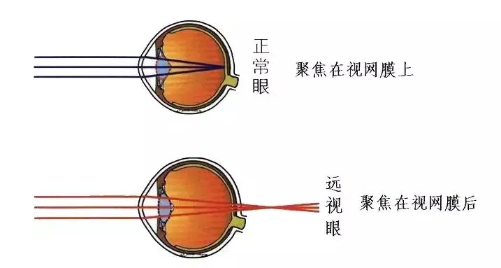 預(yù)防近視,遠(yuǎn)視性弱視