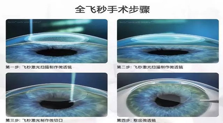 全飛秒手術(shù)區(qū)別