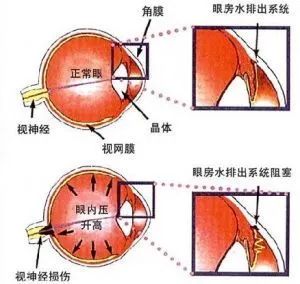 什么是青光眼