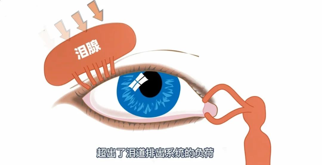 干眼屬于一種慢性疾病