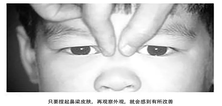 把鼻根部的皮膚稍微拎起來(lái)一點(diǎn)