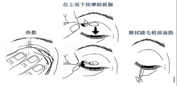 細(xì)管就是瞼板腺