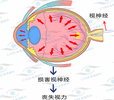 不同的青光眼類型
