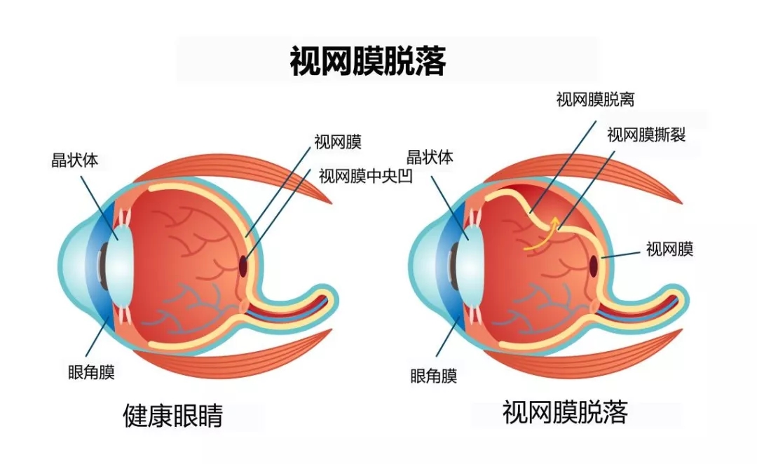 視網(wǎng)膜脫離.webp.jpg