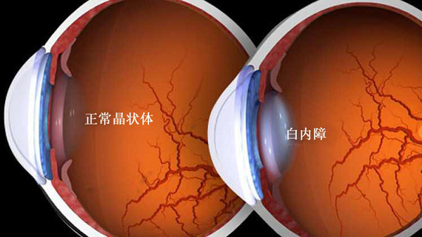 白內(nèi)障,青光眼,白內(nèi)障手術(shù),珠海希瑪眼科醫(yī)院