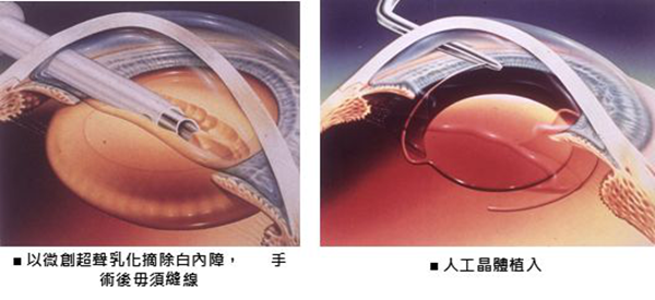 白內(nèi)障,青光眼,白內(nèi)障手術(shù),珠海?，斞劭漆t(yī)院