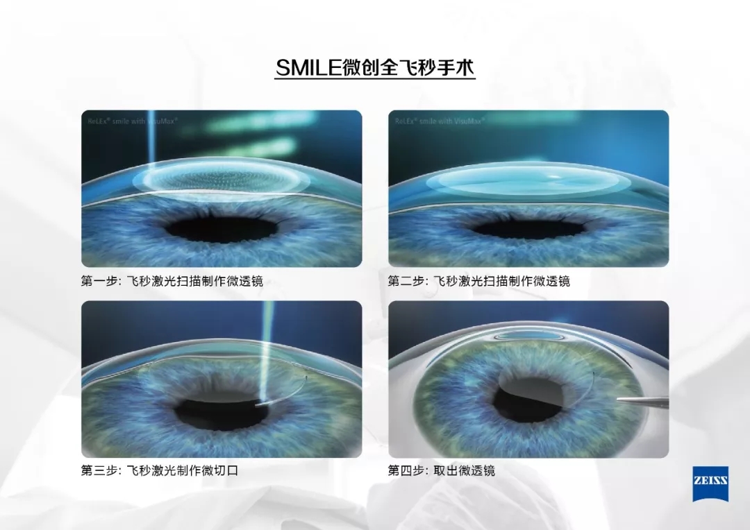 近視手術(shù),激光矯正,晶體植入式,珠海?，斞劭漆t(yī)