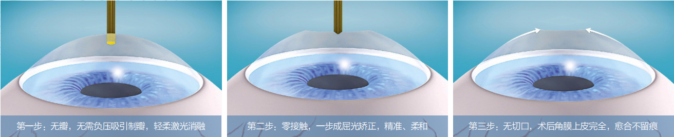 近視手術(shù),激光矯正,晶體植入式,珠海?，斞劭漆t(yī)