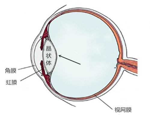 白內(nèi)障,視力模糊,色覺異常,老花眼,單眼復(fù)視,珠海