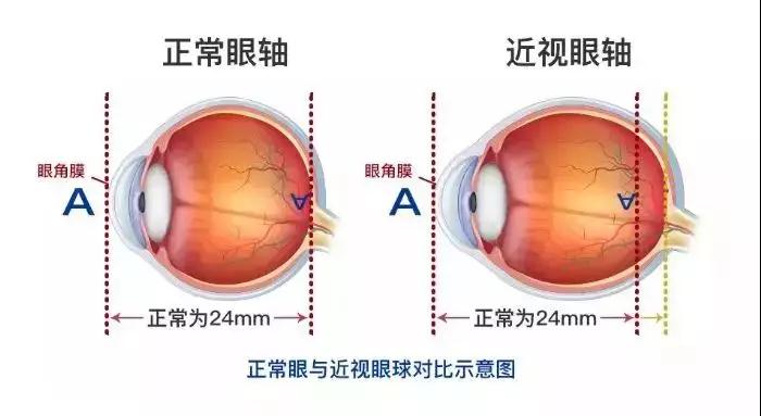 近視,小兒眼病,珠海希瑪眼科醫(yī)院