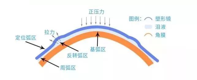 青少年近視,兒童近視,OK鏡,珠海?，斞劭漆t(yī)院