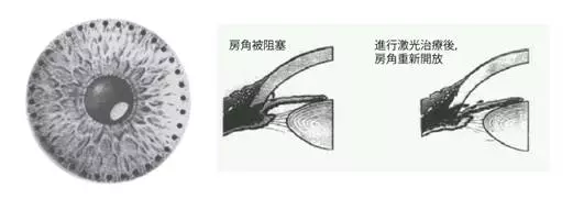 干眼癥,急性青光眼,眼中風,珠海?，斞劭漆t(yī)院