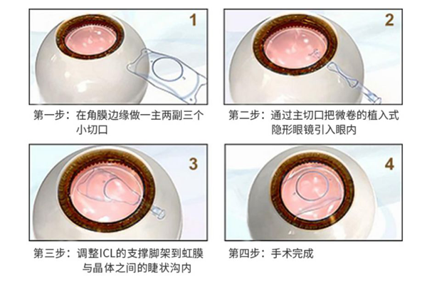 近視,治療近視，近視手術(shù)，珠海?，斞劭漆t(yī)院