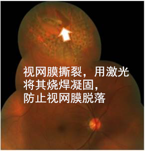 飛蚊,病癥,玻璃體,視網(wǎng)膜,珠海?，斞劭漆t(yī)院