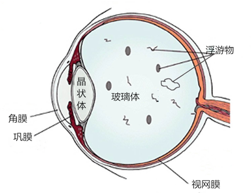 飛蚊,病癥,玻璃體,視網(wǎng)膜,珠海?，斞劭漆t(yī)院