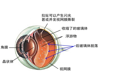 飛蚊,病癥,玻璃體,視網(wǎng)膜,珠海希瑪眼科醫(yī)院
