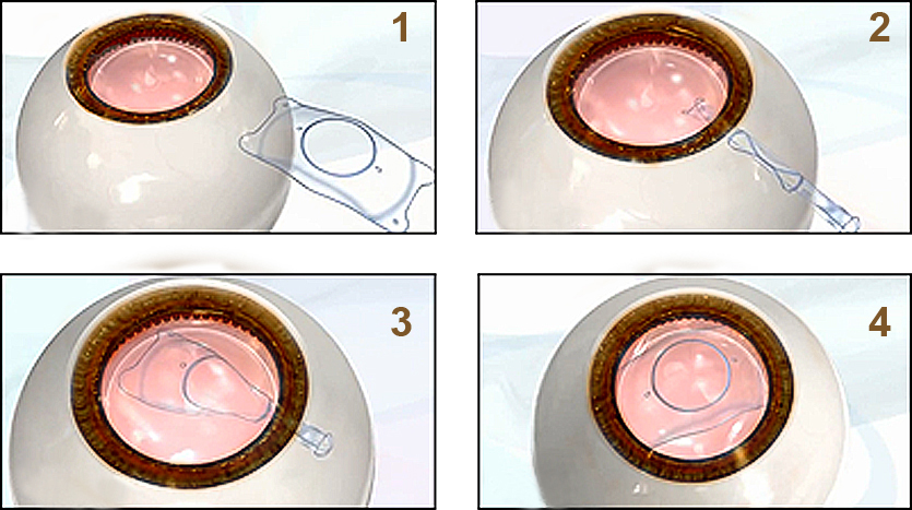 全飛秒激光近視手術(shù),半飛秒激光近視手術(shù),珠海希
