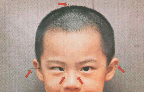內(nèi)斜視,屈光,斜視治療,珠海?，斞劭漆t(yī)院
