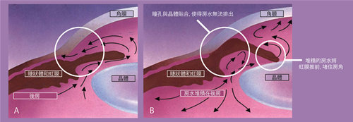 青光眼,繼發(fā)性青光眼,角膜炎,鞏膜炎,虹膜睫狀體炎,珠海?，斞劭漆t(yī)院