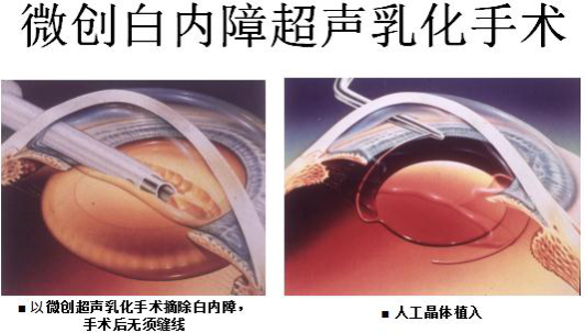 白內(nèi)障,白內(nèi)障手術(shù),飛秒白內(nèi)障手術(shù),珠海?，斞劭漆t(yī)院