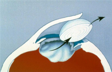 白內(nèi)障,白內(nèi)障手術(shù),飛秒白內(nèi)障手術(shù),珠海?，斞劭漆t(yī)院