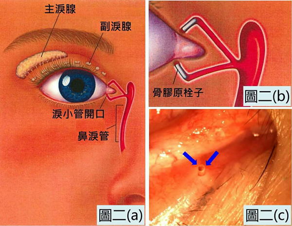 干眼癥,眼睛干澀,眼干癥,珠海?，斞劭漆t(yī)院