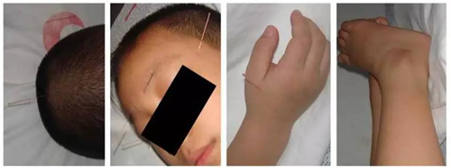 小兒眼病,小兒弱視,兒童弱視,弱視怎么辦