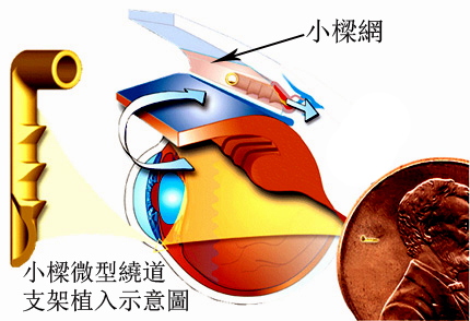 青光眼,失明性眼睛疾病,珠海希瑪眼科