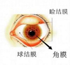 角膜炎,角膜鱗狀,角膜穿孔,珠海?，斞劭漆t(yī)院