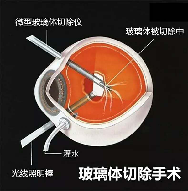 飛蚊癥,玻璃體渾濁,視網(wǎng)膜脫落,珠海?，斞劭漆t(yī)