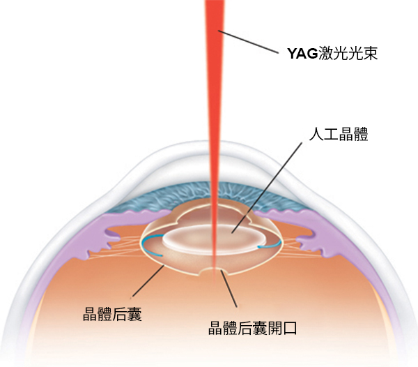 白內(nèi)障,白內(nèi)障手術(shù),珠海?，斞劭漆t(yī)院