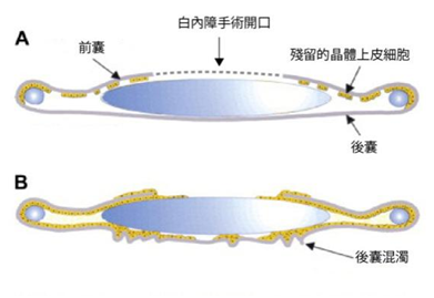 白內(nèi)障,白內(nèi)障手術(shù),珠海?，斞劭漆t(yī)院