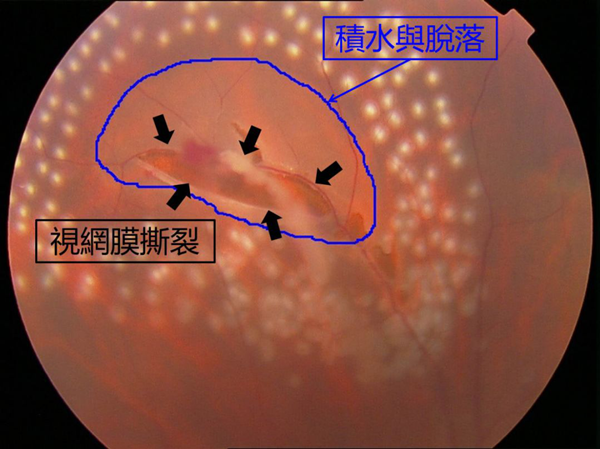 飛蚊癥,珠海治療飛蚊癥,珠海?，斞劭漆t(yī)院