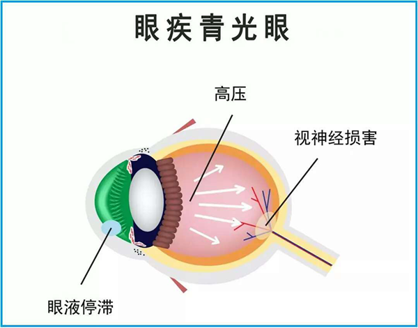 青光眼,珠海治療青光眼,珠海希瑪眼科醫(yī)院