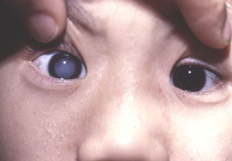 白內(nèi)障,白內(nèi)障手術(shù),珠海白內(nèi)障,珠海?，斞劭漆t(yī)