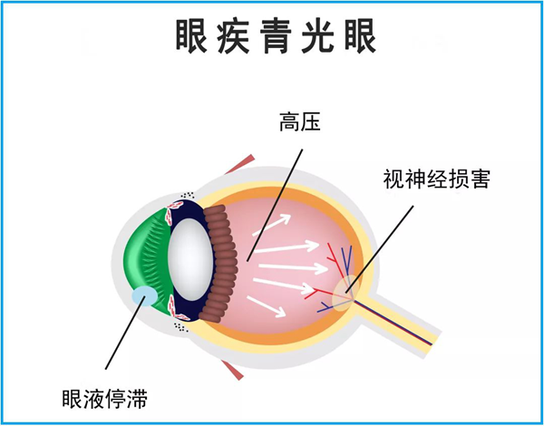 青光眼,繼發(fā)型青光眼,珠海?，斞劭漆t(yī)院