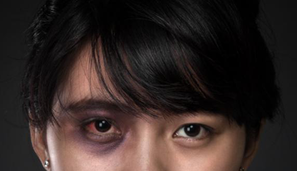 眼外傷,眼球穿孔,珠海?，斞劭漆t(yī)院