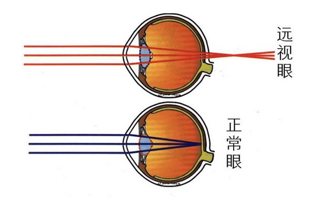 散光,散光測試,珠海希瑪眼科醫(yī)院