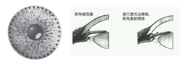 白內障,白內障手術,珠海?，斞劭漆t(yī)院