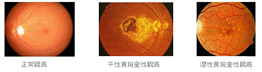 黃斑變性,黃斑水腫,珠海?，斞劭漆t(yī)院