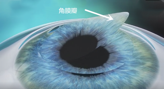 近視,近視手術(shù),珠海希瑪眼科醫(yī)院