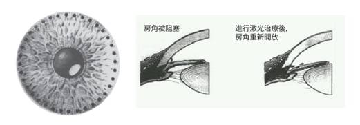 青光眼,急性青光眼,治療青光眼,珠海?，斞劭漆t(yī)院
