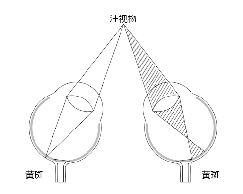 弱視,小兒弱視,治療弱視,珠海?，斞劭漆t(yī)院