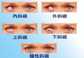 弱視,小兒弱視,治療弱視,珠海?，斞劭漆t(yī)院