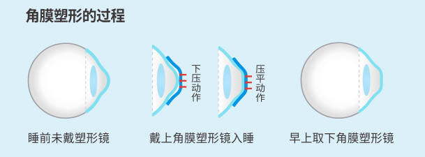 昆明配ok鏡的醫(yī)院有哪些？