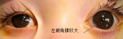青光眼,先天性青光眼,青光眼治療,珠海?，斄猪槼毖劭漆t(yī)院