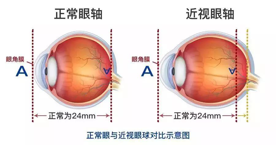 近視,珠海治療近視哪家好,珠海?，斄猪槼毖劭漆t(yī)院