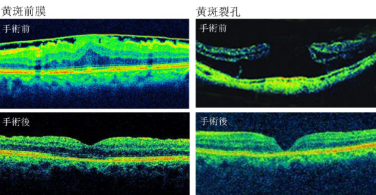 近視,珠海治療近視哪家好,珠海?，斄猪槼毖劭漆t(yī)院