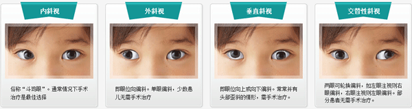 小兒斜視,小兒弱視,治療斜視,珠海?，斄猪槼毖劭漆t(yī)院